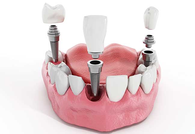 Dental Implants | Katy Texas Dentist