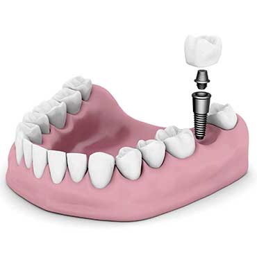 Dental Implants | Katy Texas Dentist