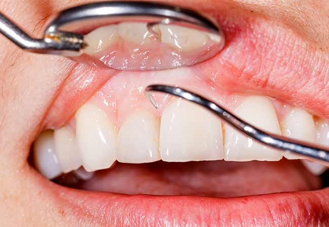 Periodontal Gum Therapy | Katy Texas Dentist