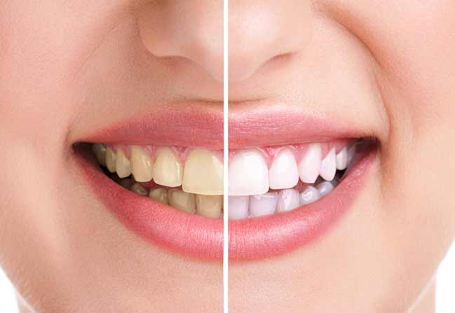 Teeth Whitening Hismile vs Zoom - Which Is Better?