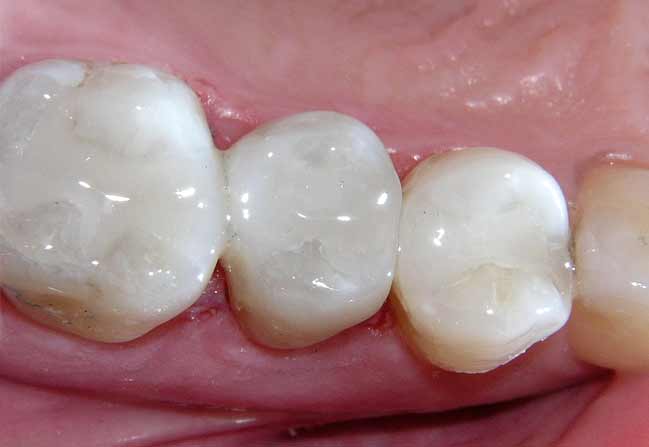 White Fillings | Katy Texas Dentist