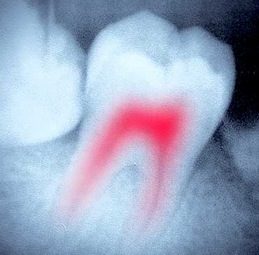 Root Canal Therapy | Katy Texas Dentist