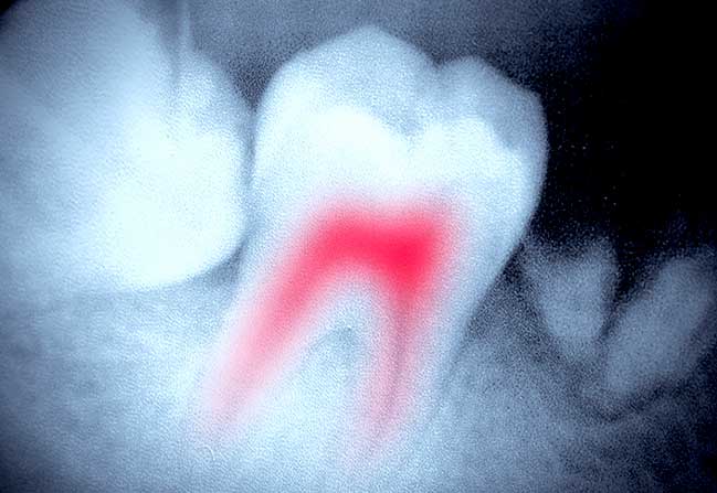 Root Canal Therapy | Katy Texas Dentist