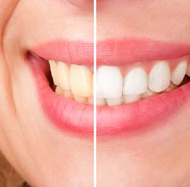 Teeth Whitening | Katy Texas Dentist